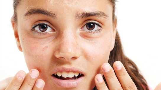 तेज धूप में लंबे समय तक रहने के कारण skin burns की समस्या हो सकती है, ऐसे में यह जानें कैसे रखें ध्यान