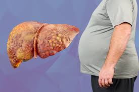 Fatty Liver की समस्या होने पर क्या मीठा खाना सुरक्षित है?