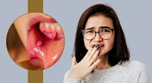 मुंह में बार-बार Blisters होना किस बीमारी का संकेत है? इससे कैसे बचाव करें?