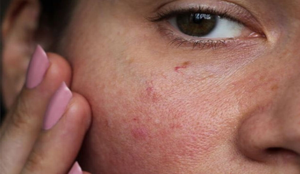 क्या चेहरे पर दिखने वाले Spots किसी रोग का संकेत हैं? जानिए