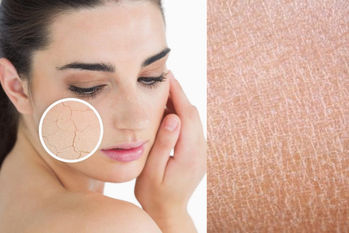 Winter Skin Care Tips: सर्दियों में ड्राई स्किन से राहत पाने के लिए आसान घरेलू उपाय